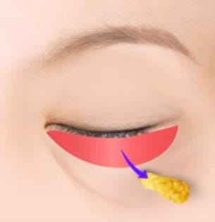 Where Is a Good Place for Under-Eye Fat Repositioning in Mok-dong? image 1