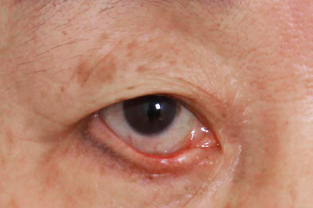 Eyelid Turning Outward After Lower Blepharoplasty image 4