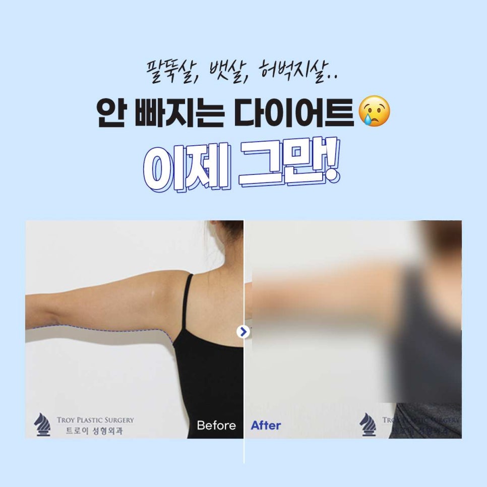 목동 트로이성형외과 지방분해주사 프로그램 인기 많은 이유 관련 이미지 6