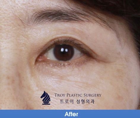 목동상안검 처진 눈 해결, 이러면 성공률 올라갑니다 관련 이미지 2