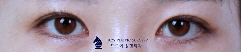 목동쌍꺼풀 수술, 나에게 어울리는 라인은? (인라인vs아웃라인) 관련 이미지 6