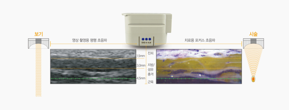 울쎄라 300샷, 600샷... 샷 수, 정말 중요할까요? 관련 이미지 4