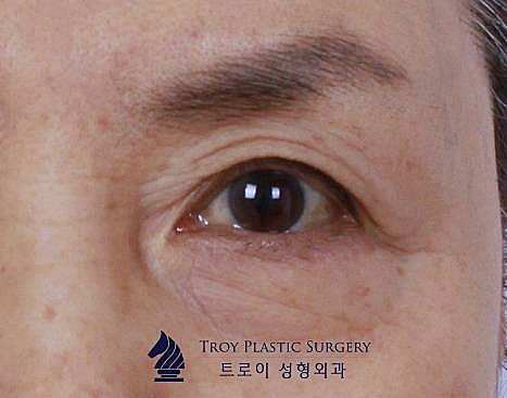 김포눈썹거상 목동까지 찾아오는 이유 관련 이미지 3