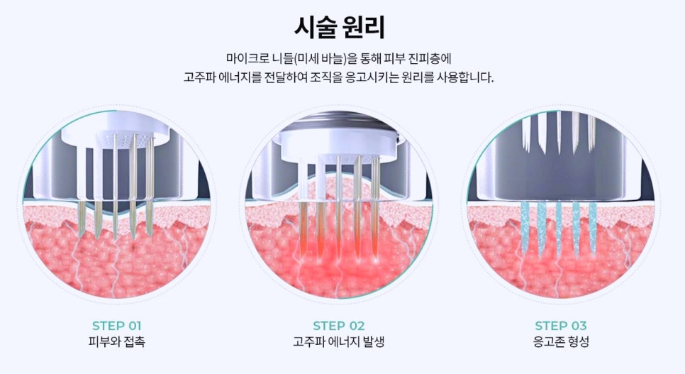 양천구피부과 포텐자 레이저 효과 제대로 보는 방법 관련 이미지 3
