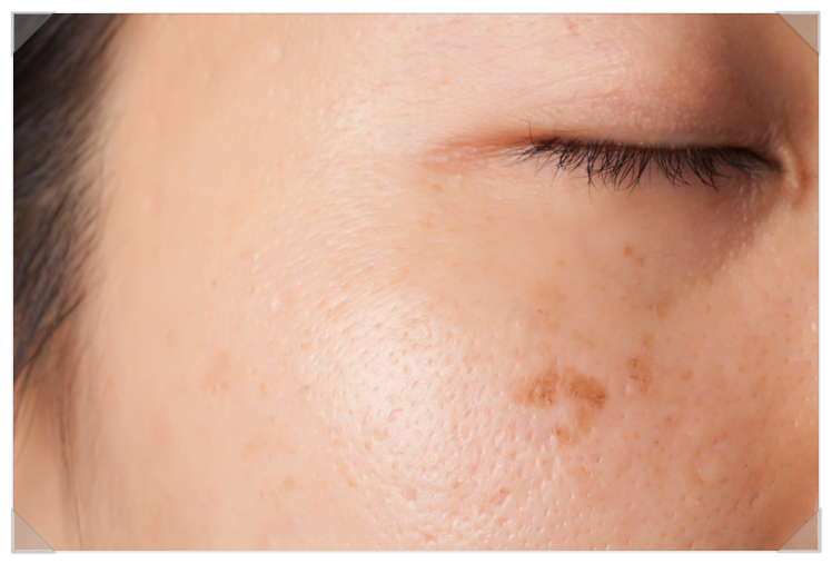 Who Is a Suitable Candidate for A-Tone Treatment for Facial Blemish Removal? image 2