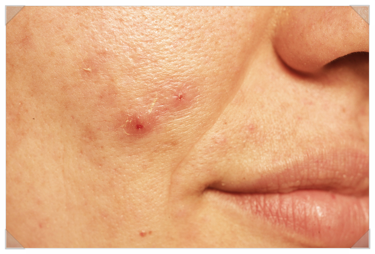 Acne Won’t Go Away: Identify the Root Cause and Treat It image 4