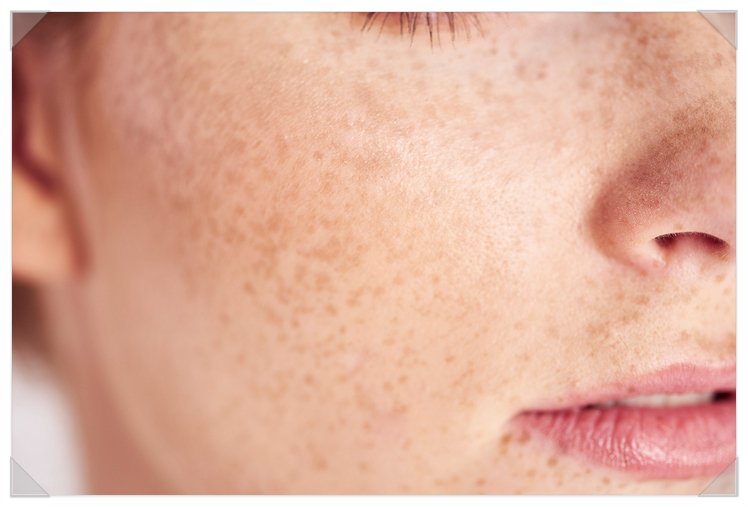 Who Is a Suitable Candidate for A-Tone Treatment for Facial Blemish Removal? image 5