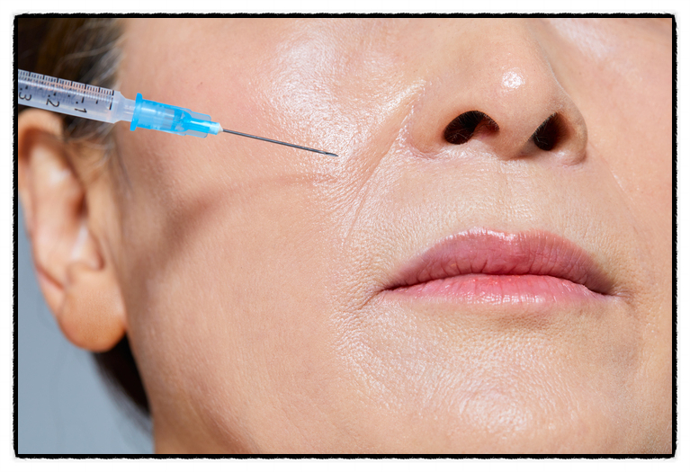 If fillers feel burdensome for nasolabial folds removal, you may want to consider Juvelook image 2