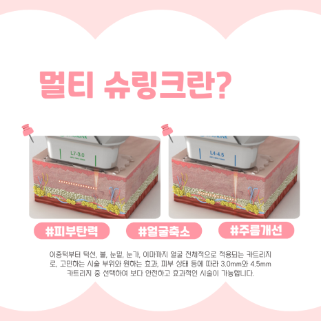 가성비 좋은 슈링크 리프팅, 원리부터 효과까지 관련 이미지 4