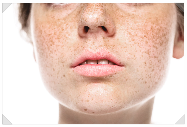 Who Is a Suitable Candidate for A-Tone Treatment for Facial Blemish Removal? image 3