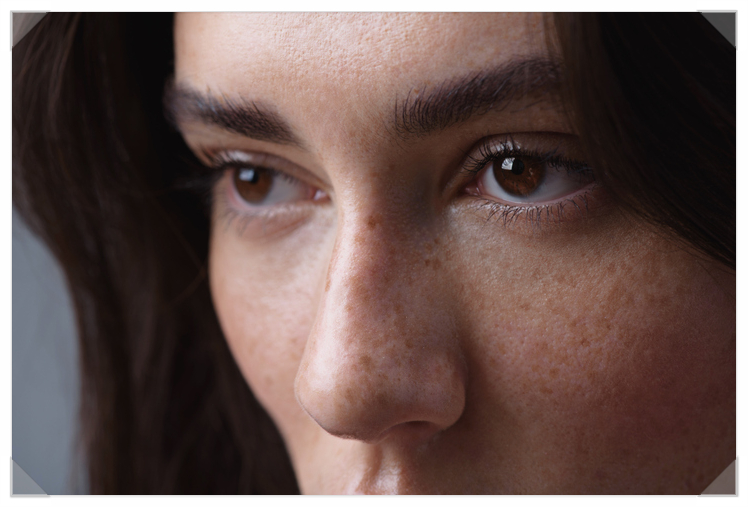 How to Tell Freckles and Melasma Apart, and Treatment Methods If You're Curious image 2