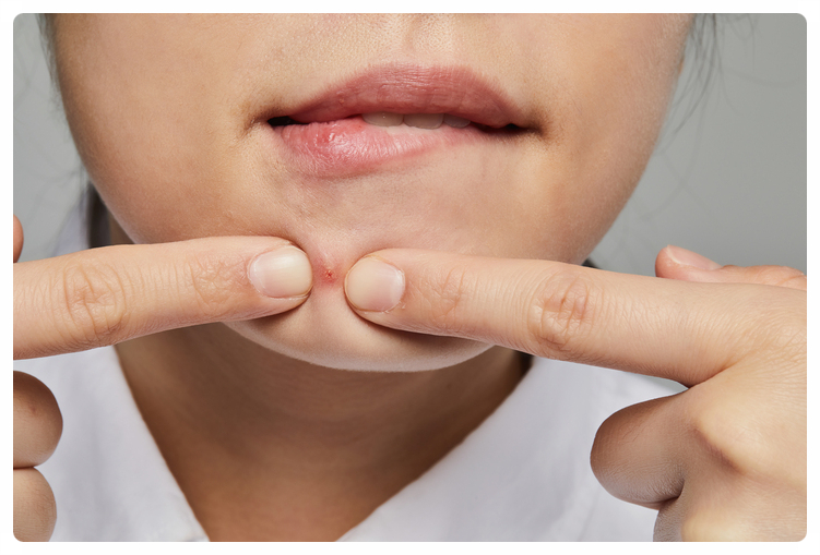 Scars Can Be Left If Pimples Around the Nose and Mouth Are Popped Incorrectly image 3