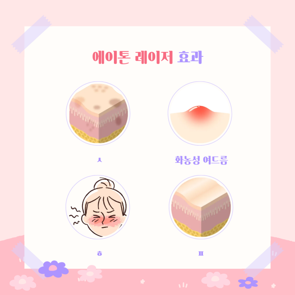 봄볕에 짙어지는 기미 올바른 치료 방법 알아보기 관련 이미지 4