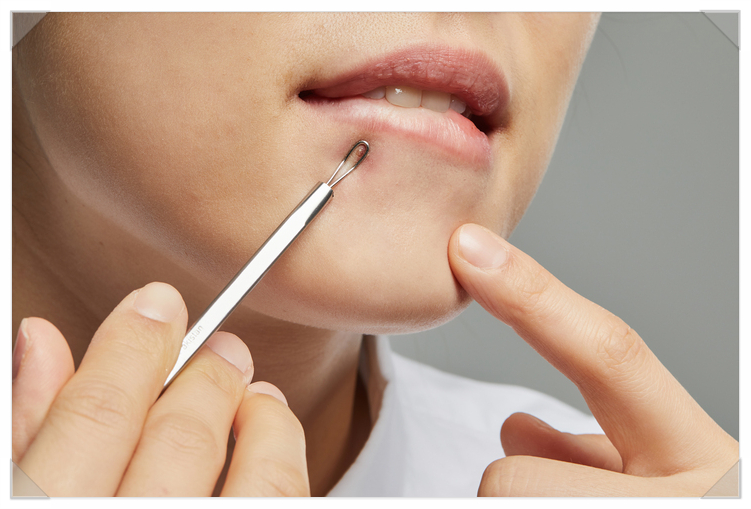 Acne Won’t Go Away: Identify the Root Cause and Treat It image 3