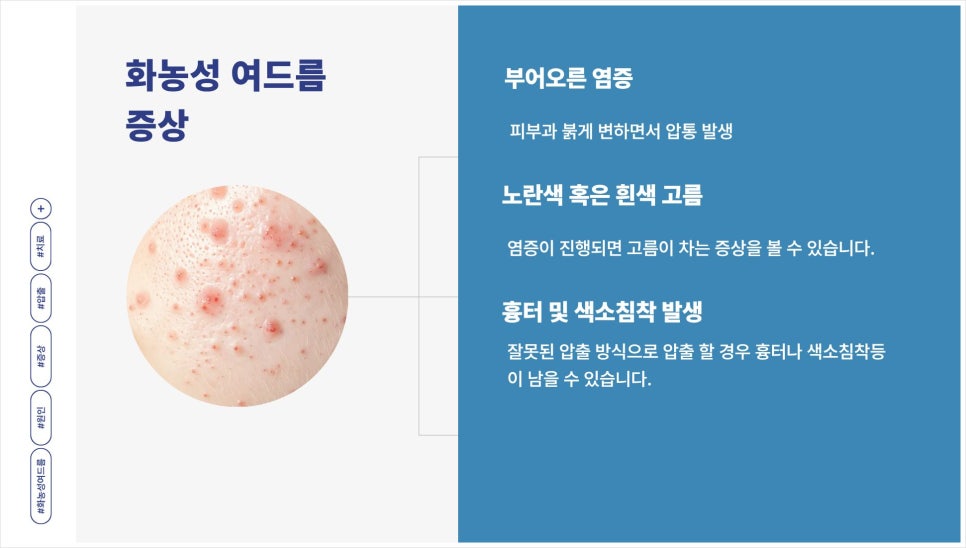 방배역피부과 붉은 화농성여드름 과연 압출만이 답일까 관련 이미지 8