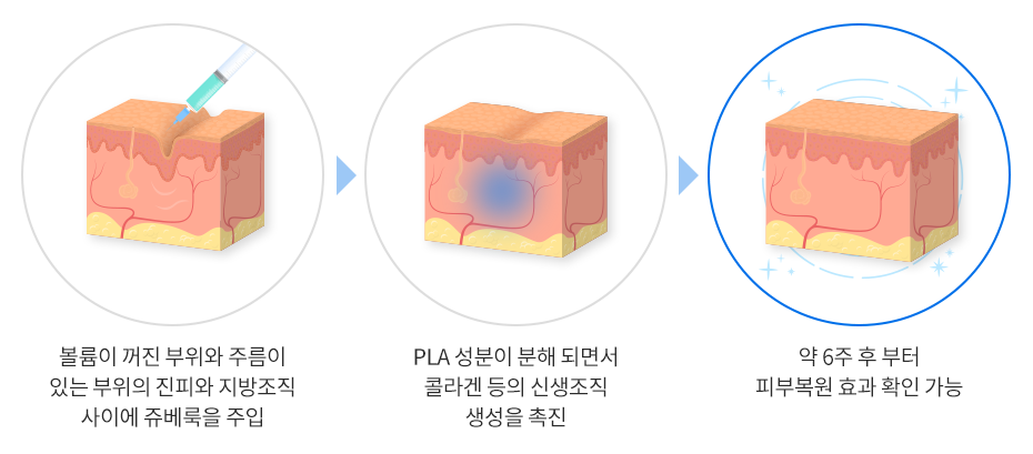 A Dermatology Specialist in Seocho-gu Explains the Characteristics of Each Type of Juvelook image 6