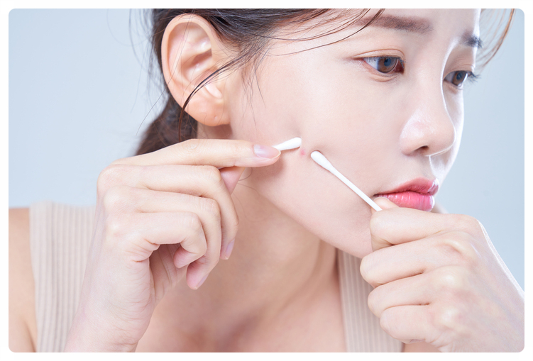 Scars Can Be Left If Pimples Around the Nose and Mouth Are Popped Incorrectly image 2