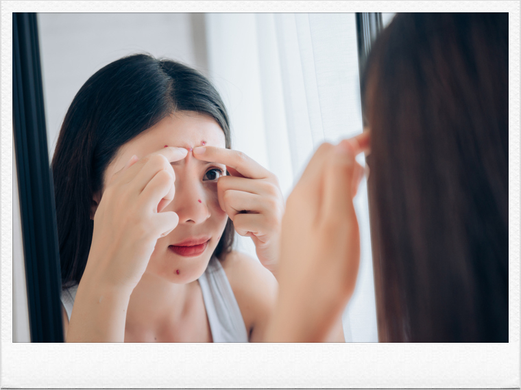 Painful Acne Treatment Requires Identifying the Root Cause image 3