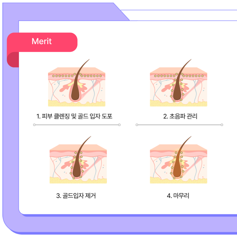 서초구피부과 여드름 레이저로 깨끗한 피부 관리 관련 이미지 3