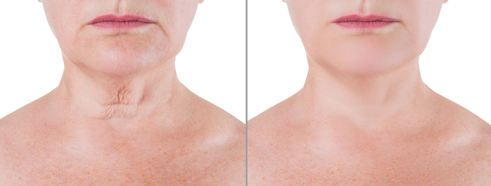 What Is the Right Way for Me to Get Rid of a Double Chin? image 4