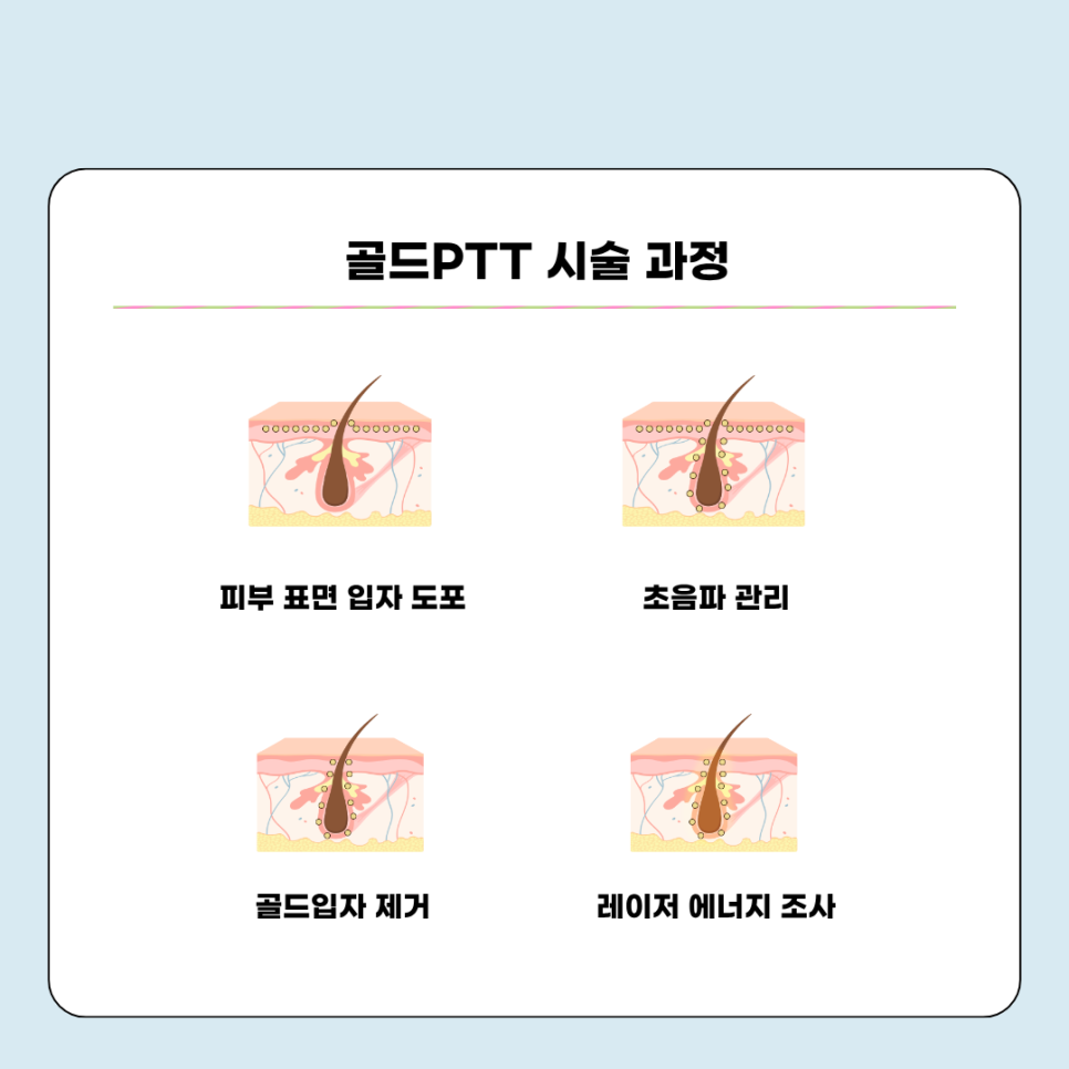 붉은여드름자국, 피지 고민에 골드PTT 치료가 도움돼 관련 이미지 4