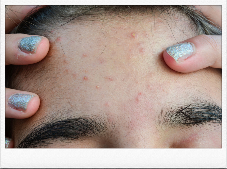 Painful Acne Treatment Requires Identifying the Root Cause image 4