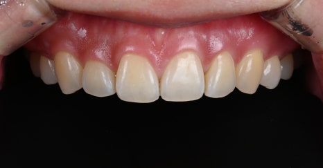 변색과 잇몸비대칭, 라미네이트 치아삭제로 변화를 주다 [+치료 사례 포함] 관련 이미지 9