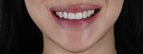 변색과 잇몸비대칭, 라미네이트 치아삭제로 변화를 주다 [+치료 사례 포함] 관련 이미지 3