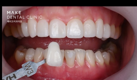 잇몸 라인 비대칭으로 미소의 자신감 회복 [+치료사례 포함] 관련 이미지 13