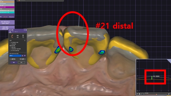 블랙트라이앵글 라미네이트로 완벽한 치아 틈메우기 [ +치료사례 포함] 관련 이미지 7