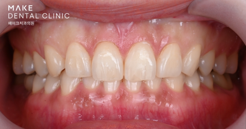 옥니라미네이트, 달라진 미소 [+치료사례 포함] 관련 이미지 15