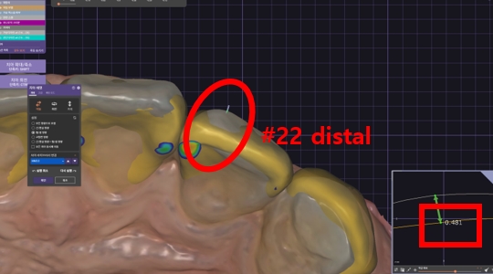 블랙트라이앵글 라미네이트로 완벽한 치아 틈메우기 [ +치료사례 포함] 관련 이미지 8