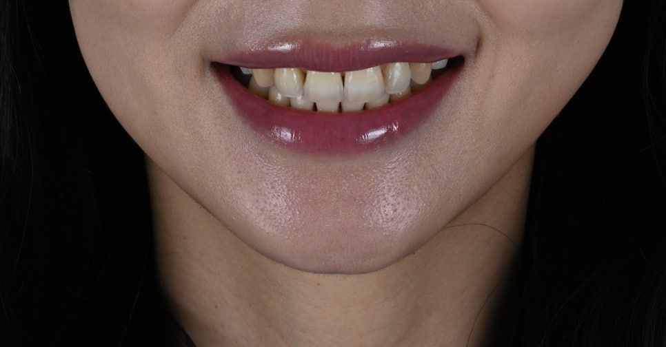 앞니 블랙트라이앵글로 웃음을 잃어버린 당신에게 [+치료 사례 포함] 관련 이미지 9