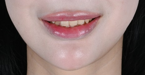 치아부분변색 때문에 웃지 못했던 하루, 이렇게 바뀌었습니다 [+치료 사례 포함] 관련 이미지 8