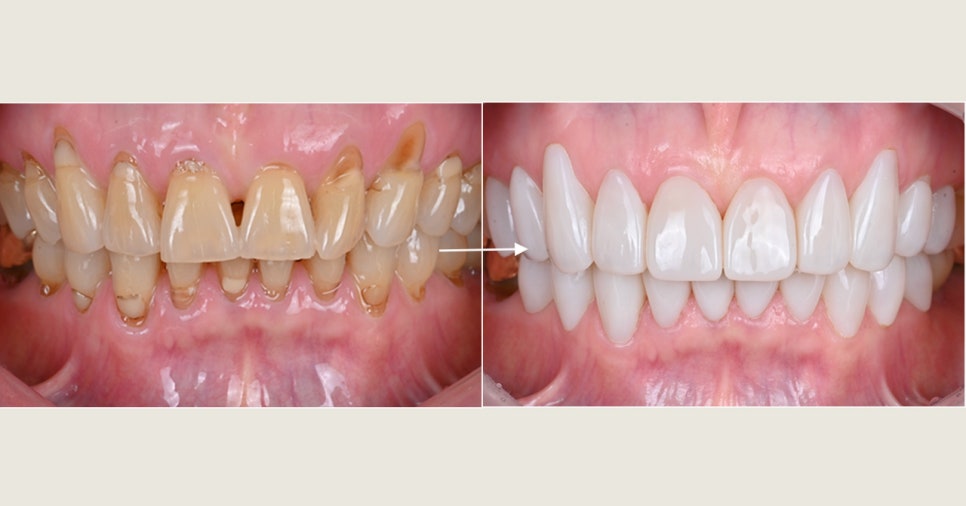 부모님 치아가 걱정된다면 한 번쯤 읽어보세요 — 중년층 구강 변화 이야기 관련 이미지 3