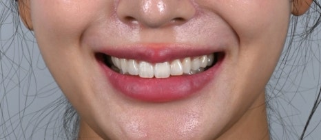 잇몸 라인 비대칭으로 미소의 자신감 회복 [+치료사례 포함] 관련 이미지 5