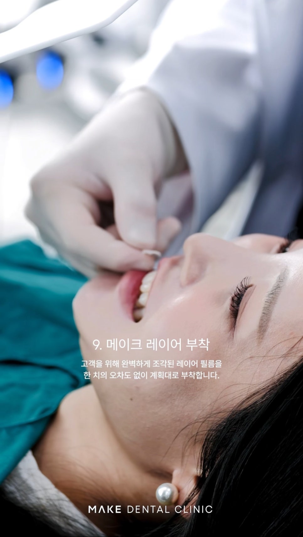 서울 치아미백, 나에게도 효과 있을까요? 관련 이미지 9