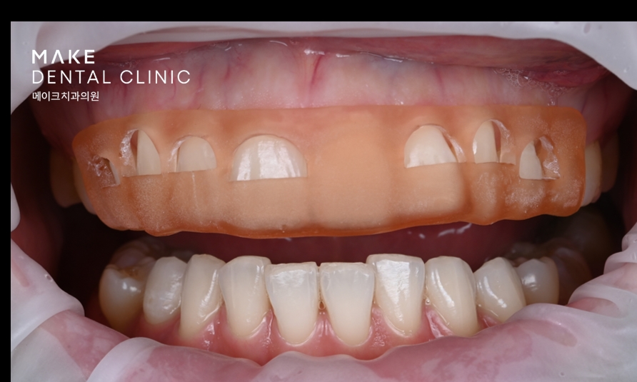 잇몸 라인 비대칭으로 미소의 자신감 회복 [+치료사례 포함] 관련 이미지 7