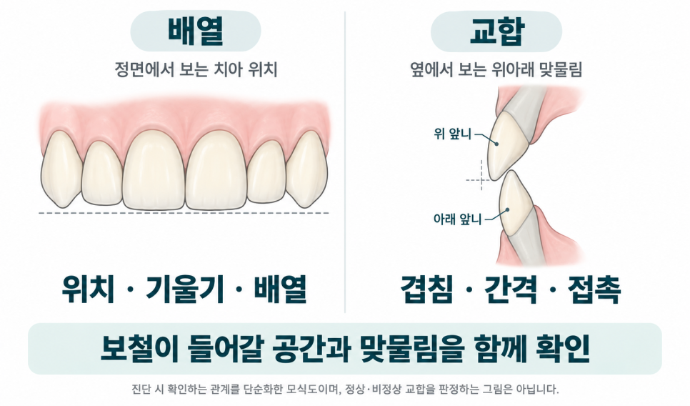 언주역 메이크치과, 라미네이트와 크라운은 치아를 덮는 범위가 어떻게 다른가요? 관련 이미지 3