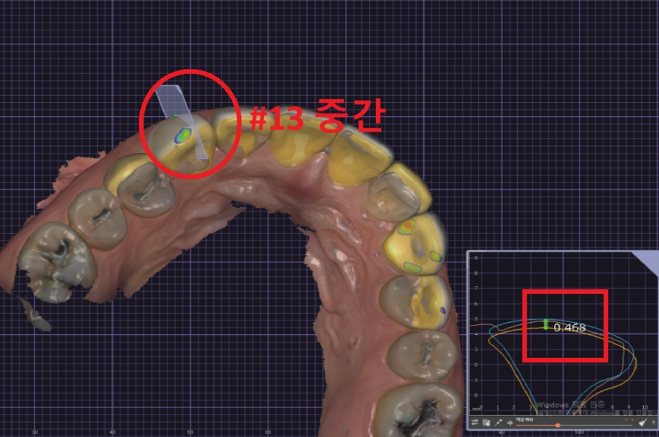 옥니라미네이트, 달라진 미소 [+치료사례 포함] 관련 이미지 11