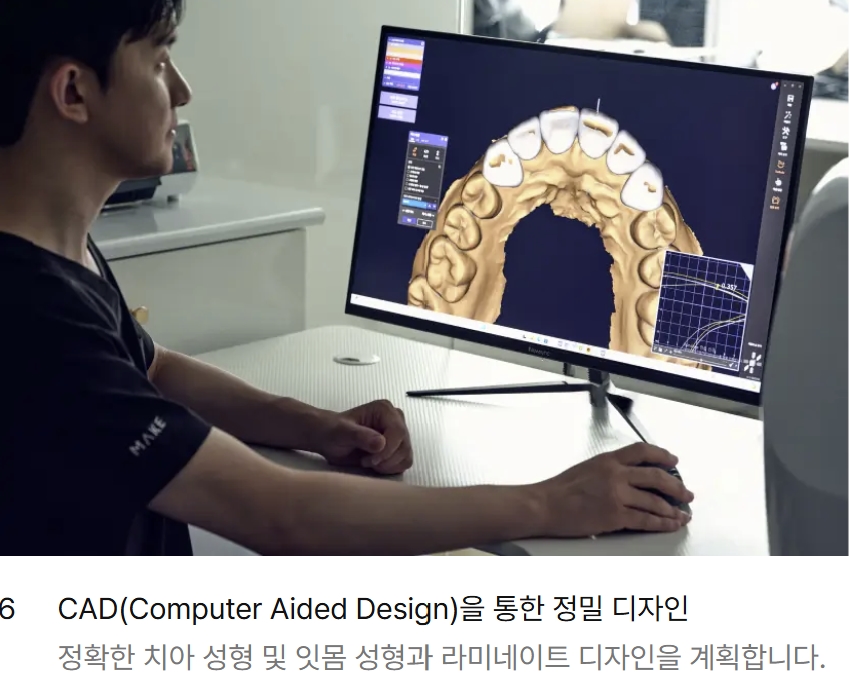 블랙트라이앵글 라미네이트로 완벽한 치아 틈메우기 [ +치료사례 포함] 관련 이미지 4