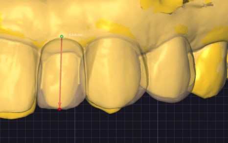 Small Teeth Concerns, Gaining Big Confidence with Small-Tooth Laminates [+Treatment Case Included] image 18