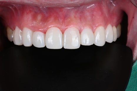 치아미백병원 라미네이트, 조화가 핵심 [+치료 사례 포함] 관련 이미지 11