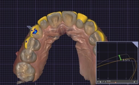 Small Teeth Concerns, Gaining Big Confidence with Small-Tooth Laminates [+Treatment Case Included] image 8