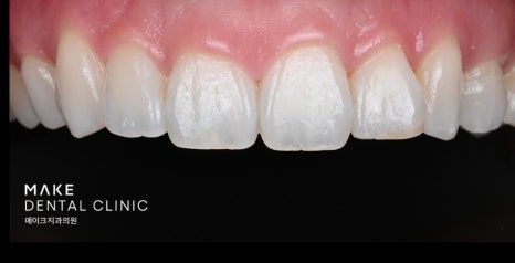 잇몸 라인 비대칭으로 미소의 자신감 회복 [+치료사례 포함] 관련 이미지 8