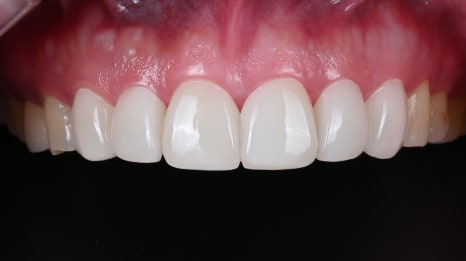 치아 파절 치료하고 다시 웃을 수 있을까요? [+치료 사례 포함] 관련 이미지 8