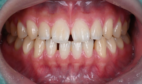 앞니 벌어짐 라미네이트 삭제 걱정 끝 [+치료 사례 포함] 관련 이미지 11