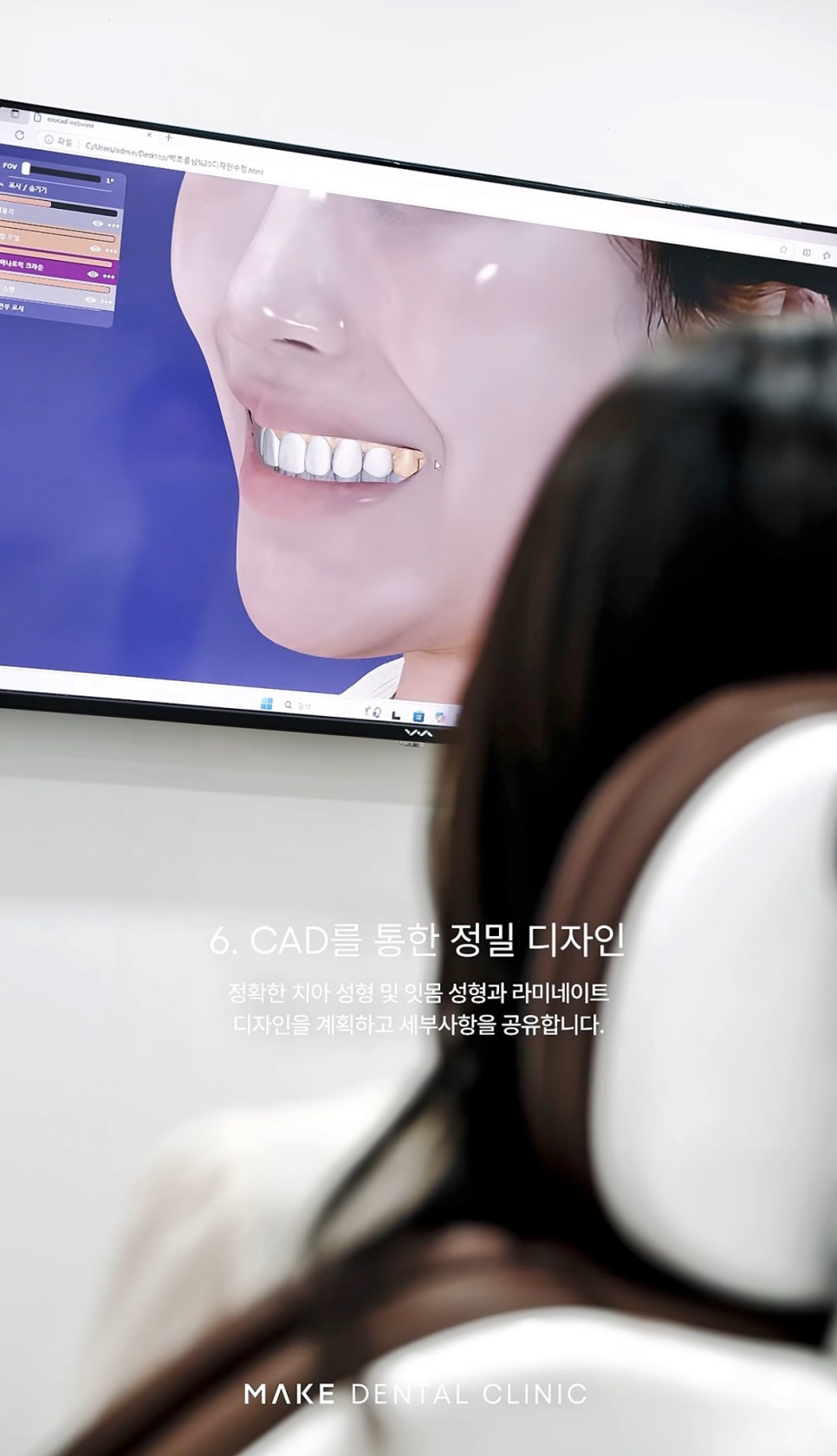 반포역치과 바쁜 직장인을 위한 주말 라미네이트 진료 가이드 관련 이미지 9