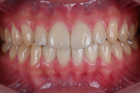 앞니 벌어짐 라미네이트 삭제 걱정 끝 [+치료 사례 포함] 관련 이미지 12