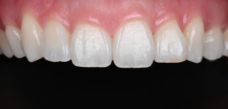 잇몸 라인 비대칭으로 미소의 자신감 회복 [+치료사례 포함] 관련 이미지 14